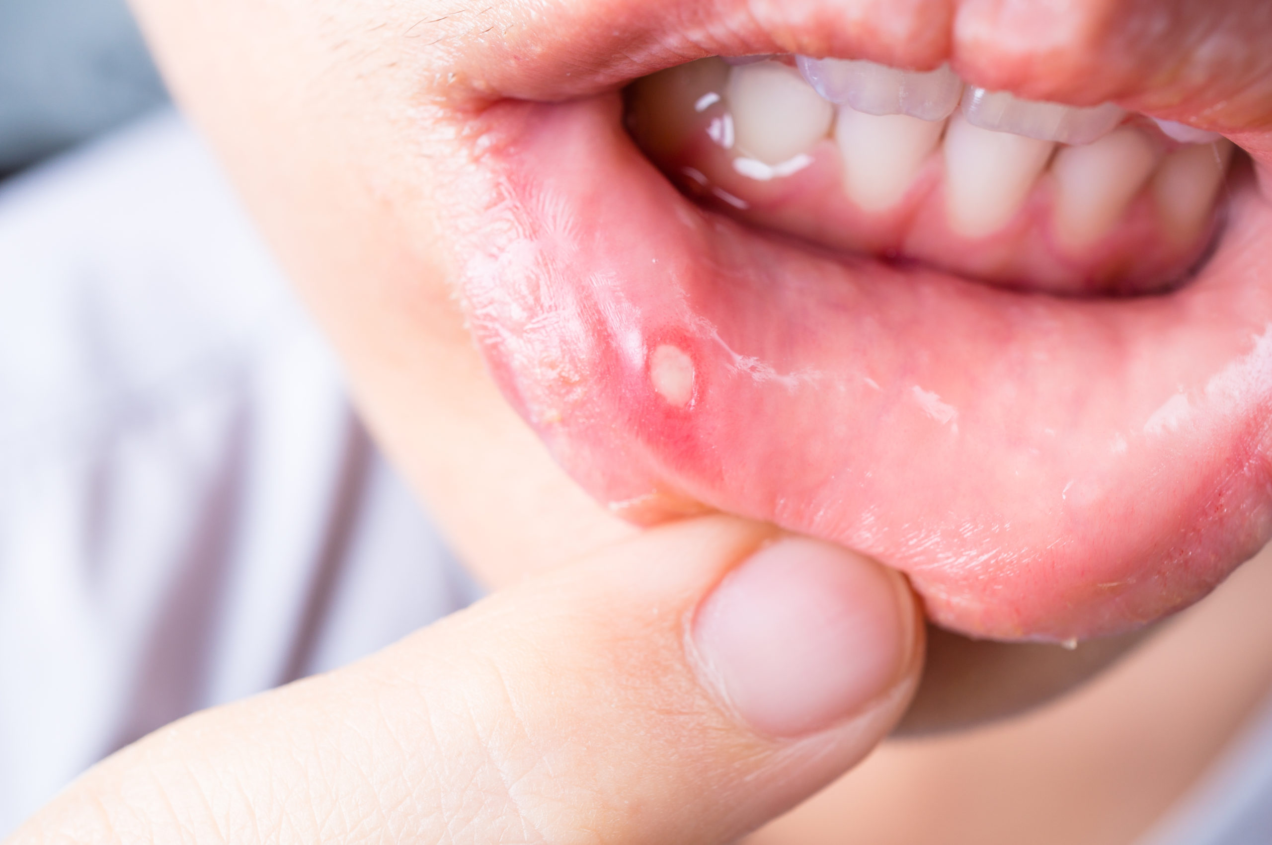 a pique, a brle, c'est un APHTE - Ma Bouche Ma Sant