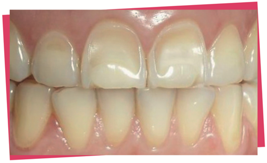 L’ÉROSION dentaire, attention aux acides ! Ma Bouche Ma Santé